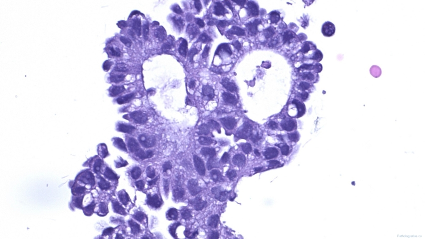 Low grade serous neoplasm