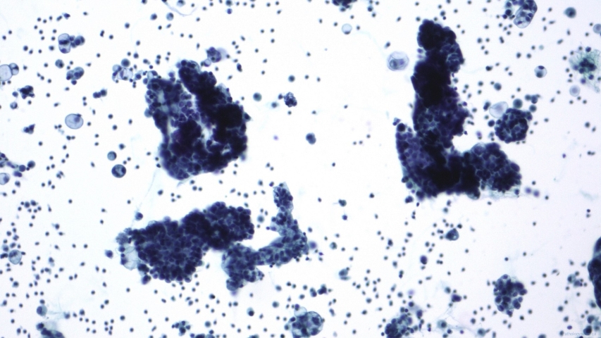 Low grade serous neoplasm