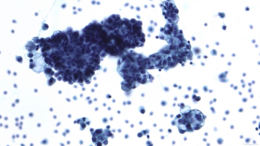 Low grade serous neoplasm