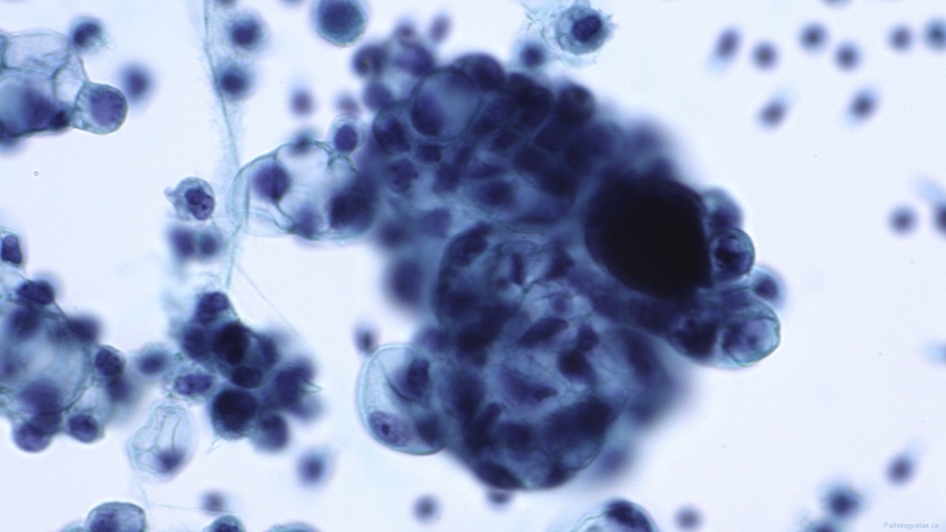 Low grade serous neoplasm