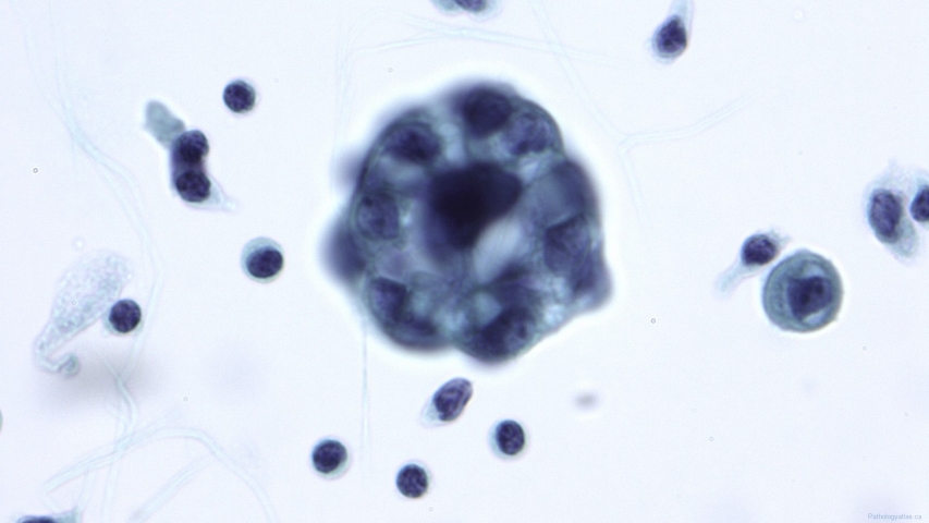 Low grade serous neoplasm