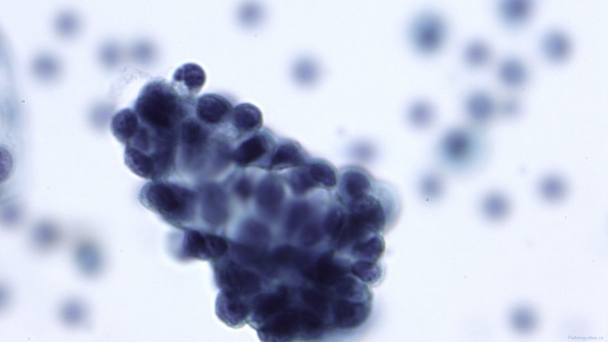 Low grade serous neoplasm