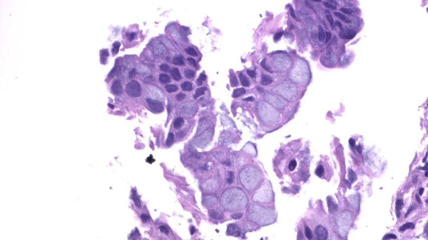Mucinous adenocarcinoma