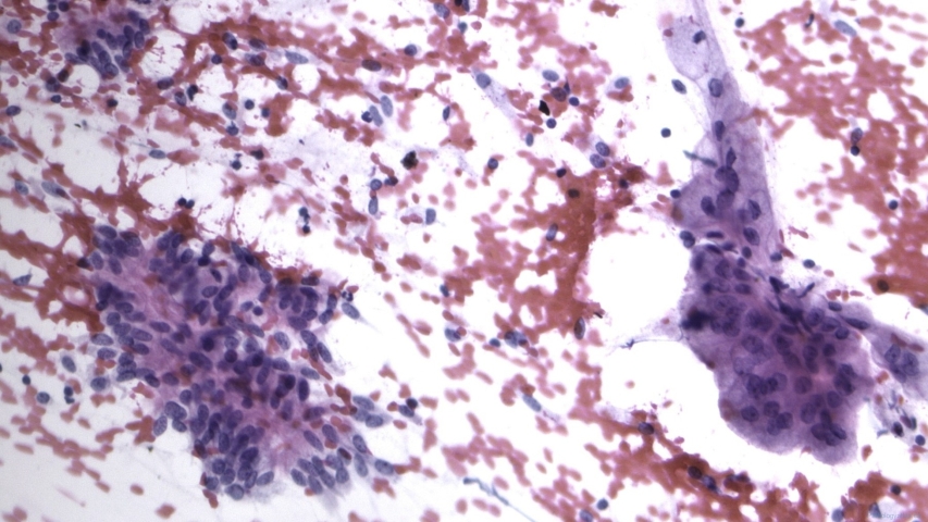 Mucinous adenocarcinoma