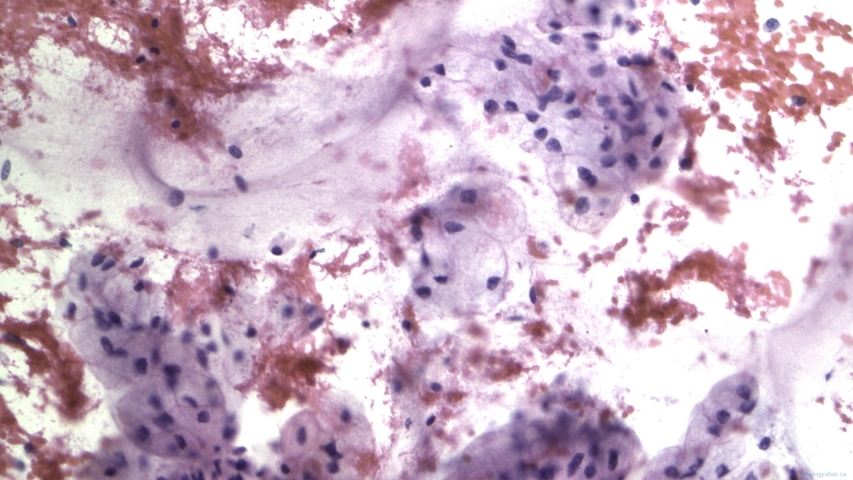 Mucinous adenocarcinoma