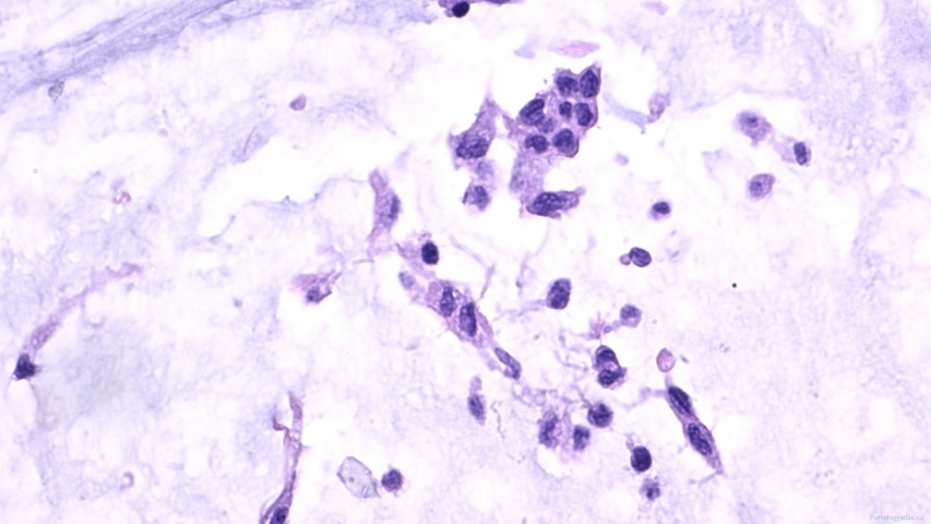 Pseudomyxoma peritonei