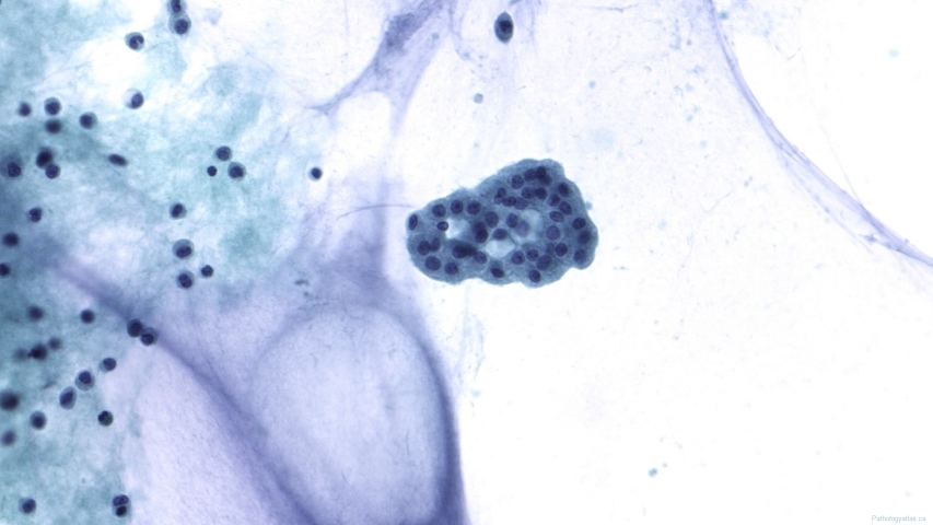 Pseudomyxoma peritonei