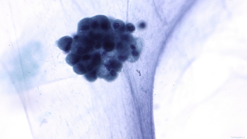 Pseudomyxoma peritonei
