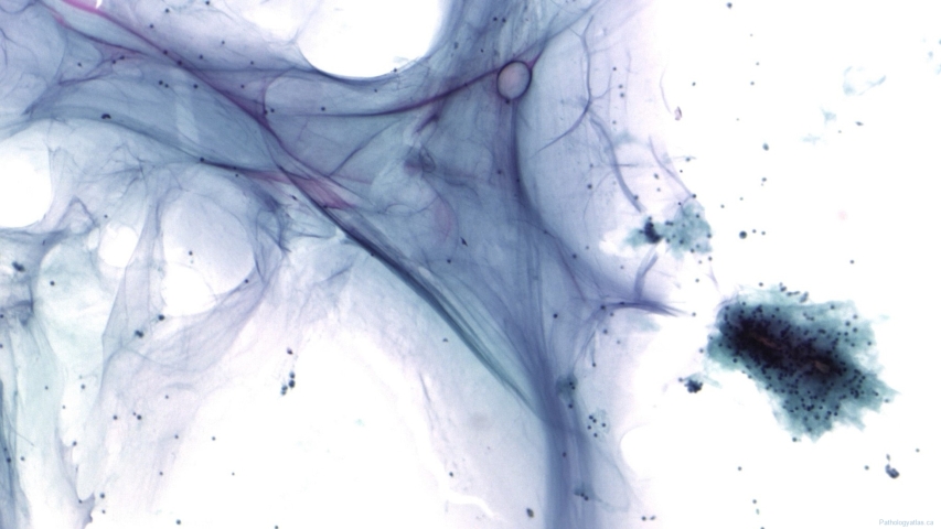 Pseudomyxoma peritonei