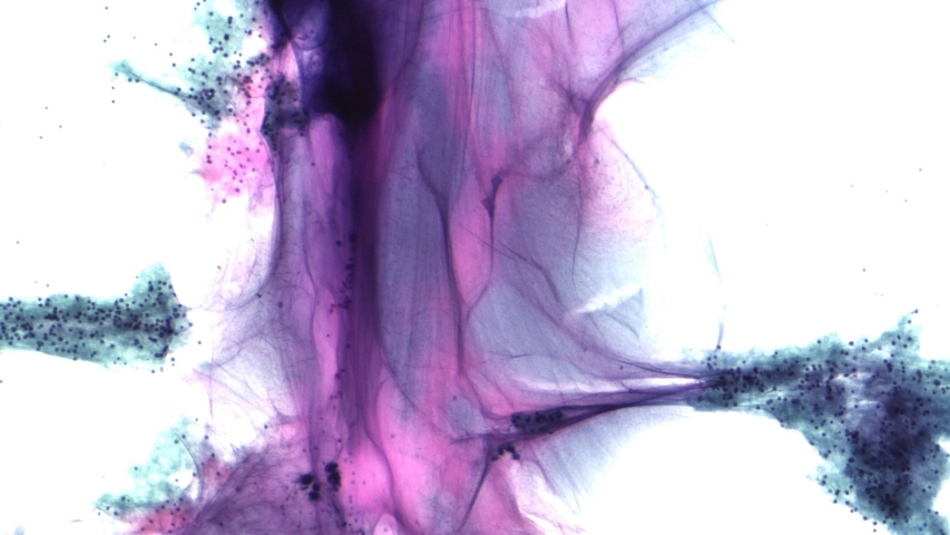Pseudomyxoma peritonei