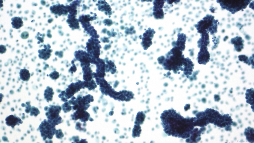 Mesothelioma