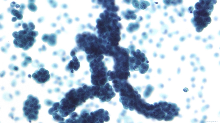 Mesothelioma