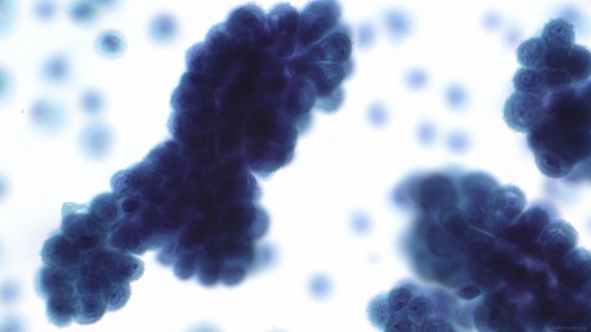 Peritoneal-fluid-MesotheliomaMesothelioma-SurePath-40X-4