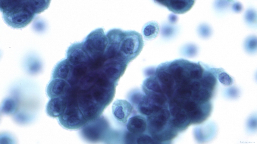 Mesothelioma