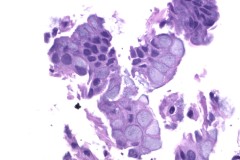 Mucinous adenocarcinoma