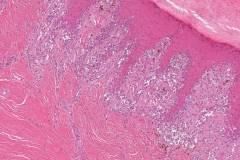 Acral melanoma