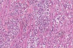 Acute appendicitis