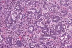 Adenocarcinoma of the ampulla