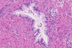 Adenocarcioma of the cervix