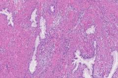Adenocarcioma of the cervix