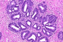 Adenocarcioma of the cervix