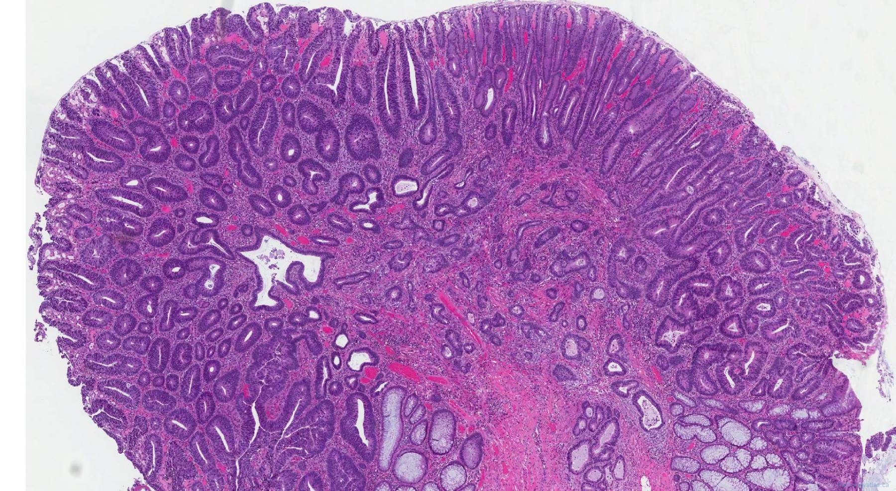 Adenocarcinoma of the colon atlas of pathology