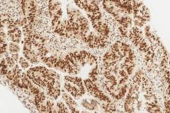 Adenocarcinoma of the colon