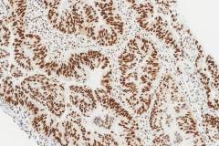 Adenocarcinoma of the colon