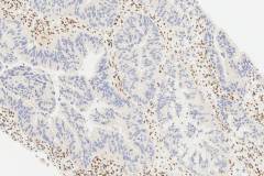 Adenocarcinoma of the colon