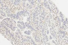 Adenocarcinoma of the colon