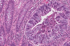 Adenocarcinoma of the colon