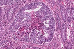 Adenocarcinoma of the colon