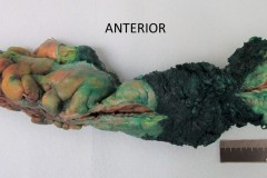 Resection of the rectum and sigmoid colon for adenocarcinoma