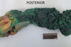 Resection of the rectum and sigmoid colon for adenocarcinoma