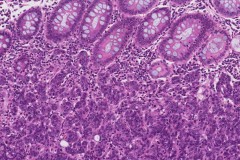 Poorly differentiated adenocarcinoma of the colon