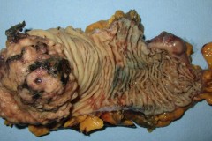 Adenocarcinoma of the right colon