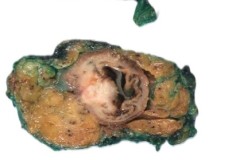 Well differentiated invasive adenocarcinoma of the rectum