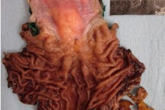 Post neoadjuvant adenocarcinoma of the esophagus