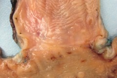 Residual adenocarcinoma of the esophagus post radiation therapy