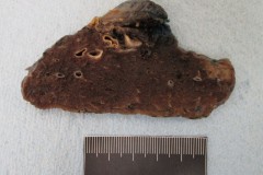 Adenocarcinoma of the lung: Subpleural tumour