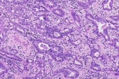 Adenocarcinoma of the lung
