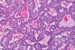 Adenocarcinoma of the lung