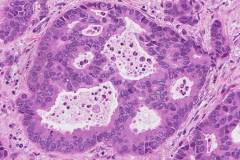 Adenocarcinoma of the lung