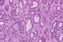 Adenocarcinoma of the lung