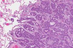 Adenocarcinoma of the lung