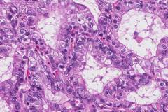 Adenocarcinoma of the lung