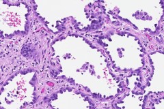 Adenocarcinoma of the lung