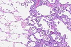 Adenocarcinoma of the lung