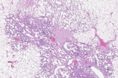 Adenocarcinoma of the lung