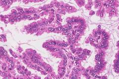 Adenocarcinoma of the lung
